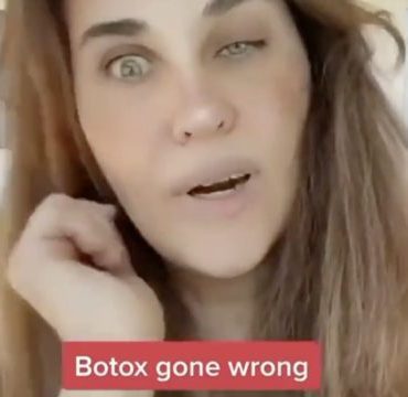 When Using Botox Goes Wrong!